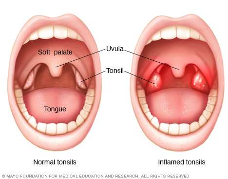 tonsils become infected is called tonsillitis in children